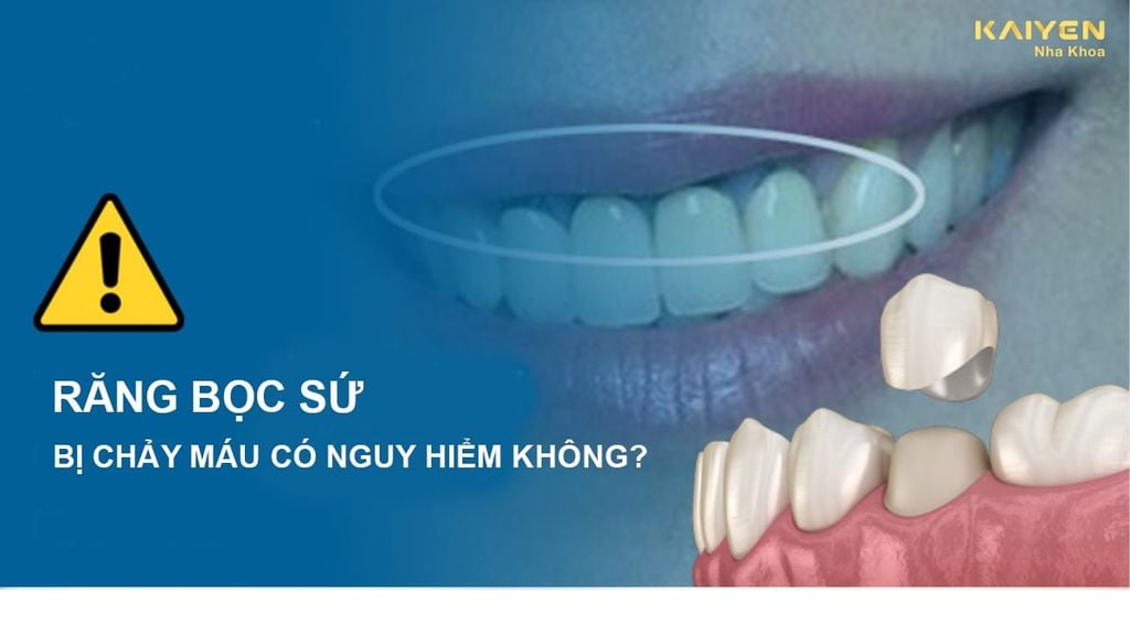 Răng bọc sứ bị chảy máu có nguy hiểm không? Cách khắc phục ra sao?
