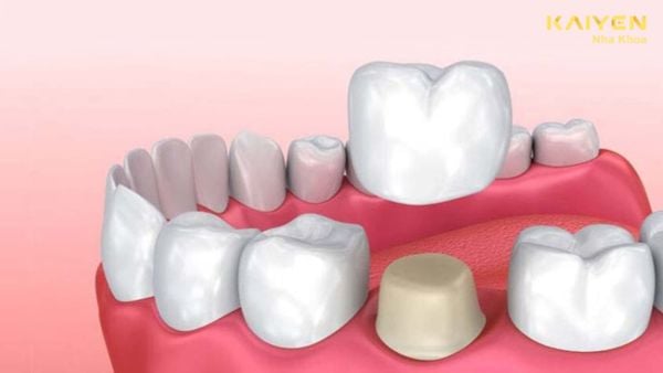 Răng bọc sứ bị viêm tủy có nguy hiểm không? Nguyên nhân và cách khắc phục