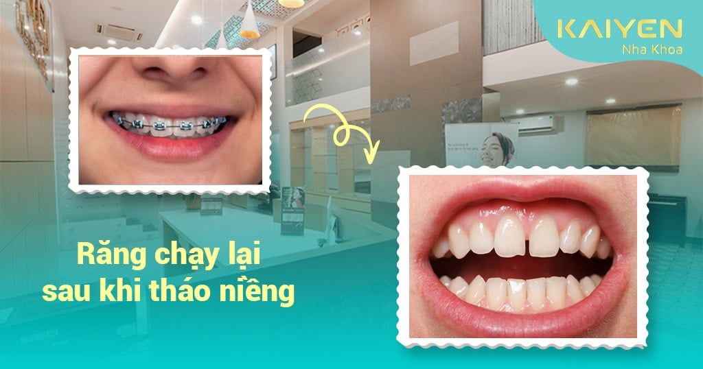 Nguyên nhân răng chạy lại sau tháo niềng? Cách phòng ngừa và khắc phục