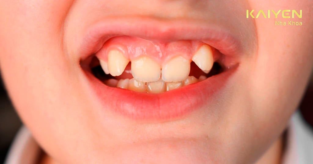 Răng chuột là gì? Có tác động như thế nào đến sức khỏe?