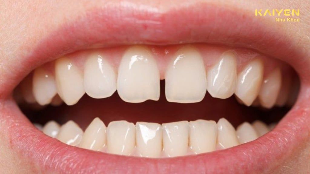 Răng cửa thưa: Nguyên nhân và cách khắc phục