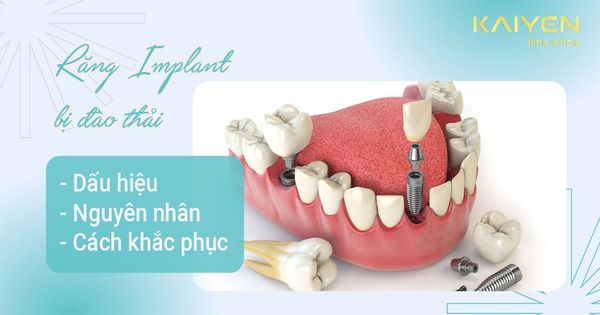 Cấy Implant bị đào thải như thế nào? Nguyên nhân và cách khắc phục