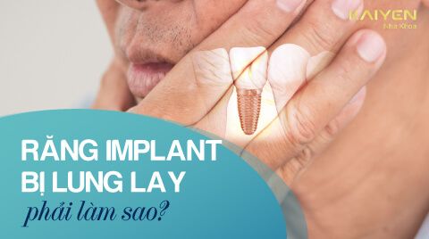Răng implant bị lung lay? Cách khắc phục nhanh tình trạng lung lay