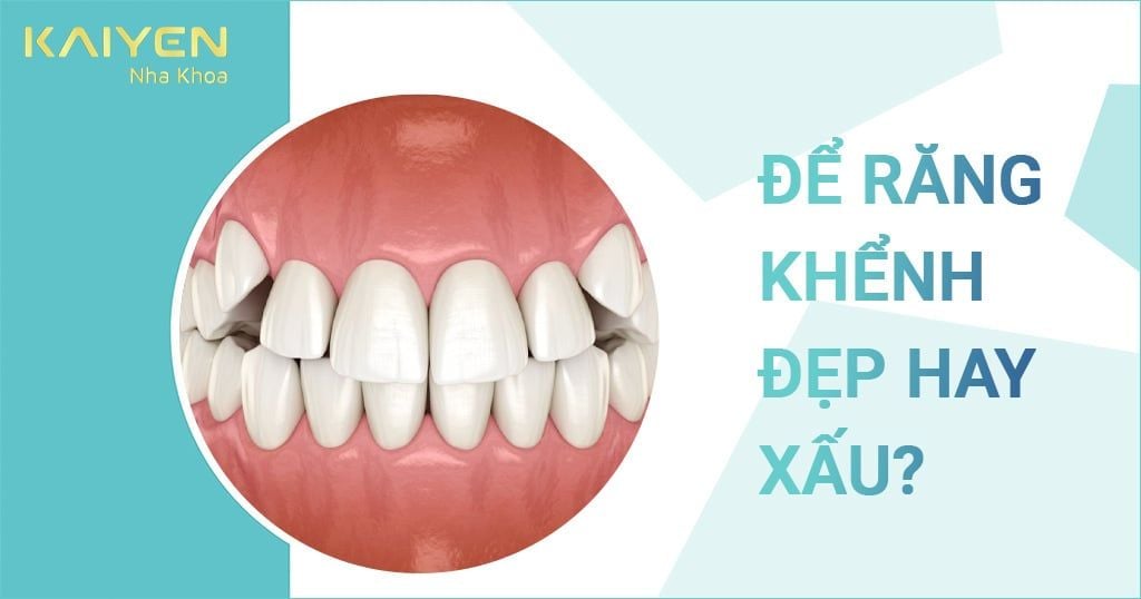 Răng khểnh đẹp hay xấu? Răng khểnh có ý nghĩa gì?