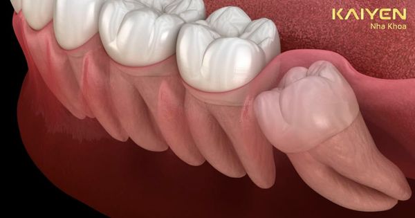 Răng khôn mọc lệch ra má: Biến chứng và cách xử lý kịp thời