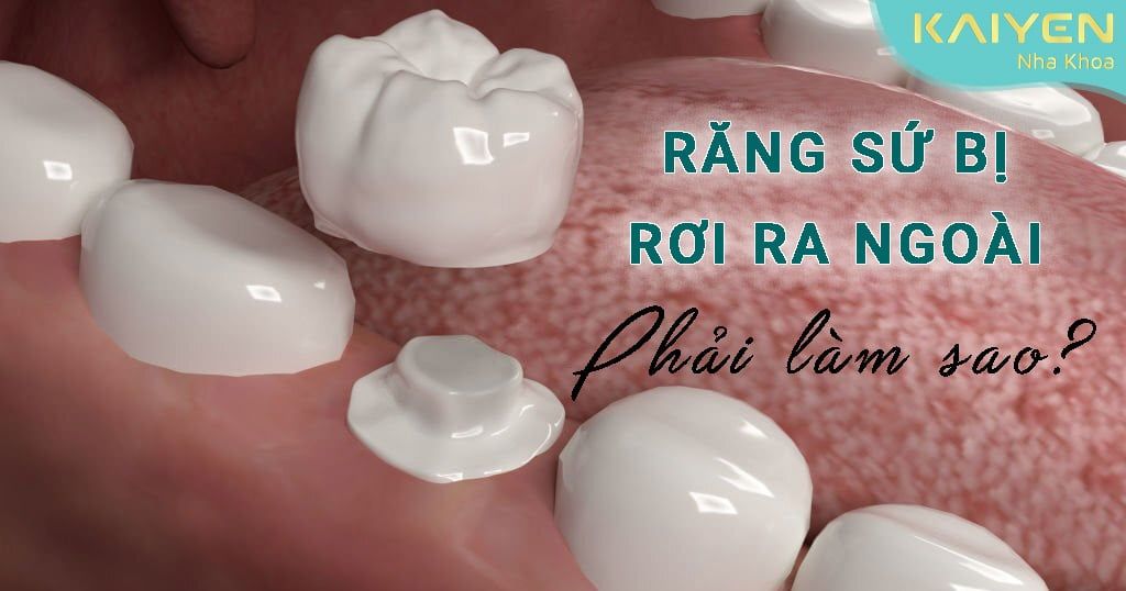 Răng sứ bị rớt ra ngoài phải làm sao? Nguyên nhân và cách khắc phục