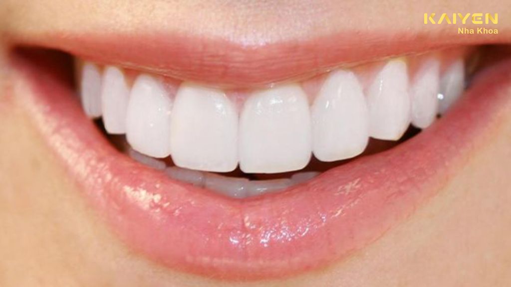 Răng sứ có bị vàng không? Nguyên nhân và cách khắc phục hiệu quả