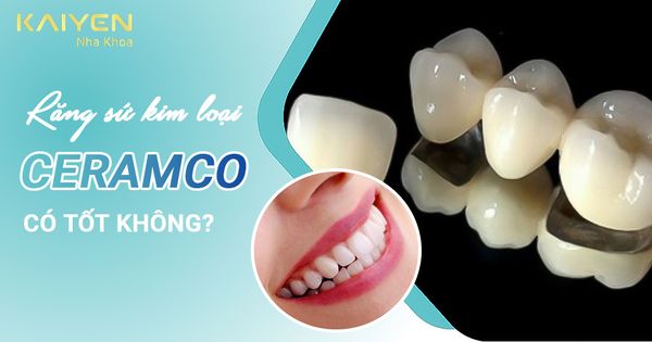 Răng sứ kim loại Ceramco là gì? Có tốt không?