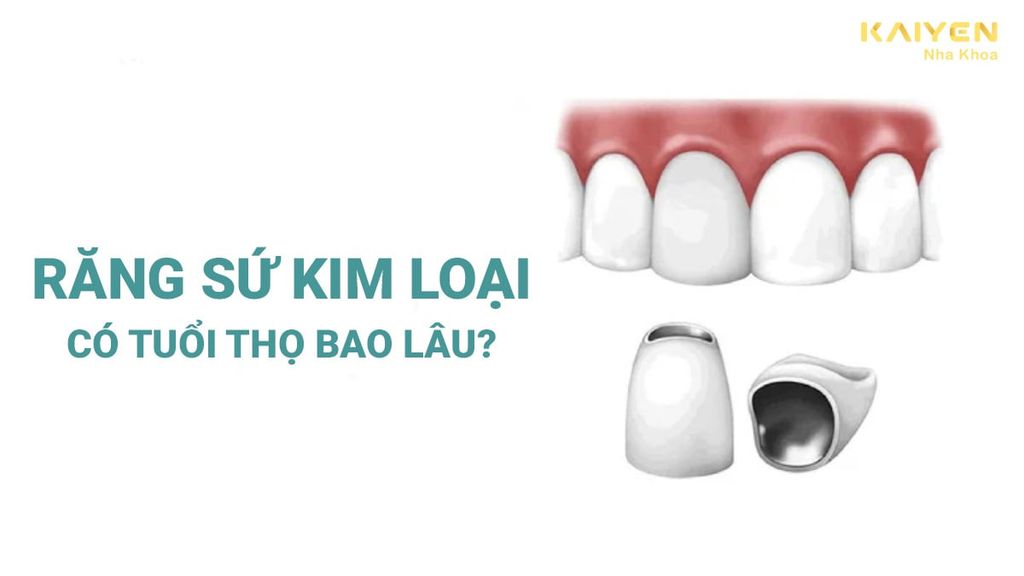 Răng sứ kim loại có tuổi thọ bao lâu? Mẹo giúp răng tuổi thọ răng sứ