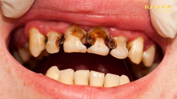 Sâu chân răng: Nguyên nhân và cách phòng ngừa hiệu quả