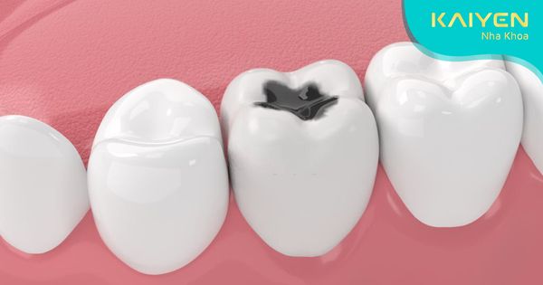 Sâu răng gây hôi miệng: Cách khắc phục triệt để bệnh lý