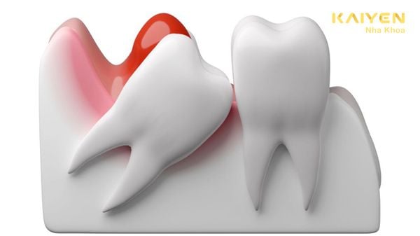 Sưng Nướu Răng Khôn: Nguyên Nhân Và Cách Điều Trị