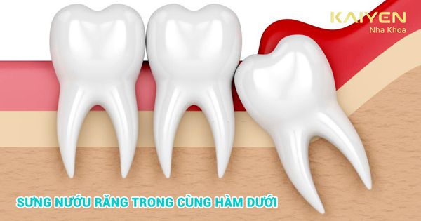 Sưng nướu răng trong cùng: Dấu hiệu, nguyên nhân và cách điều trị