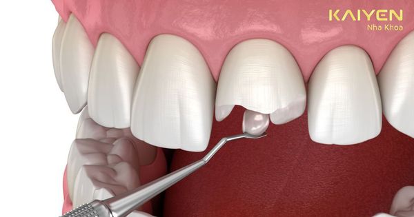 Tác hại của việc trám răng sai kỹ thuật và tự trám răng tại nhà