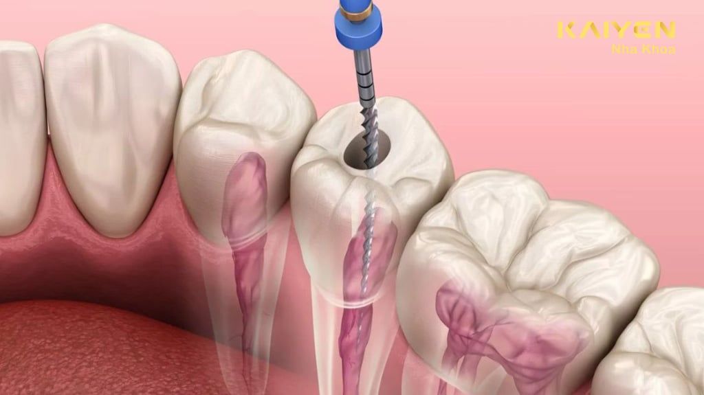 Tại Sao Phải Lấy Tủy Răng Nhiều Lần