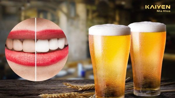 Sau khi tẩy trắng răng có được uống bia không?