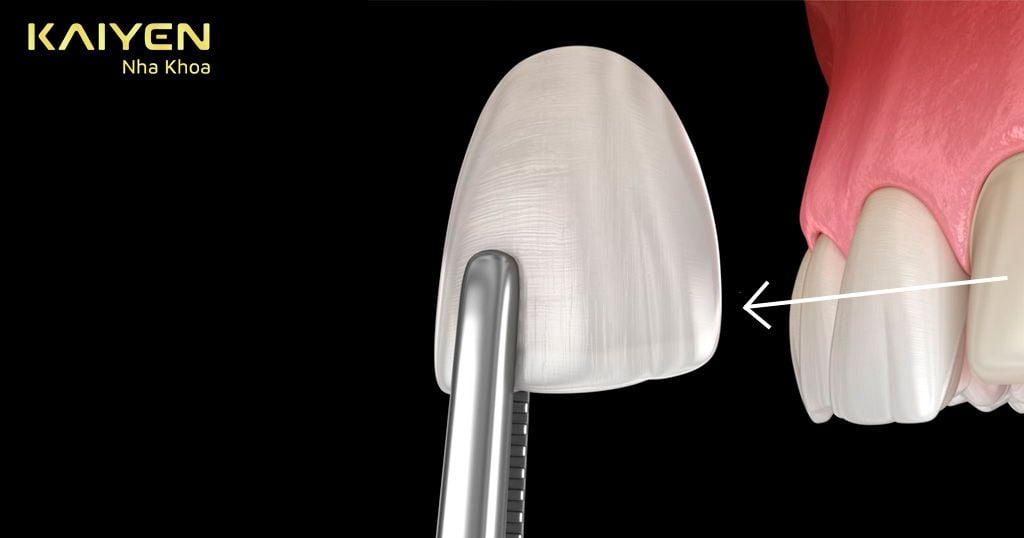 Tháo răng sứ có đau không? Tháo ra có bọc sứ lần 2 được không?