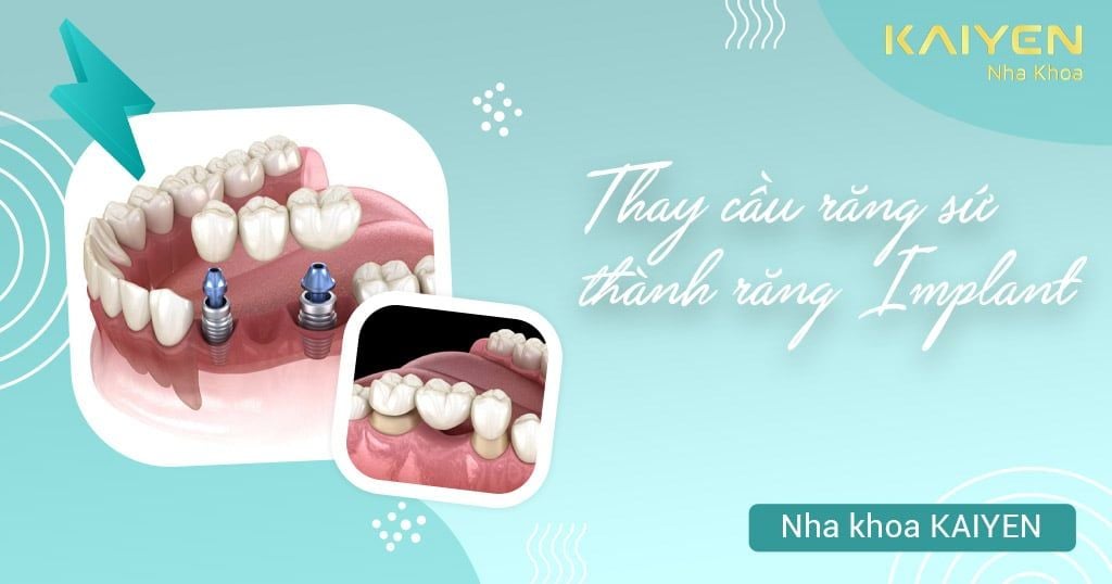 Thay cầu răng sứ bằng răng Implant: Quy trình và những lưu ý