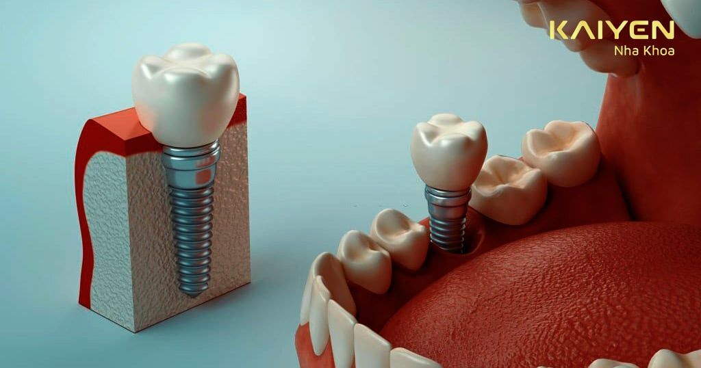 Tiêu chuẩn xương hàm trong cấy ghép Implant: Những điều cần biết