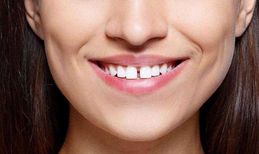 Trám Răng Thưa Có Tốt Không? Nên Trám Ở Đâu? – Nha khoa Quốc Tế KAIYEN