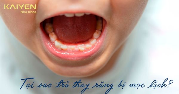Trẻ thay răng mọc lệch phải làm sao? Nguyên nhân và giải pháp