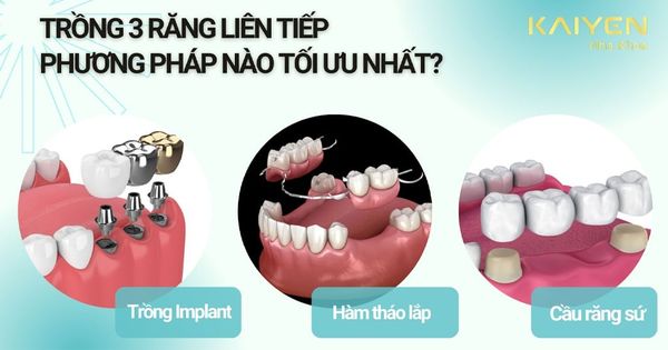 Trồng 3 răng liên tiếp: Phương pháp nào hiệu quả và tiết kiệm?
