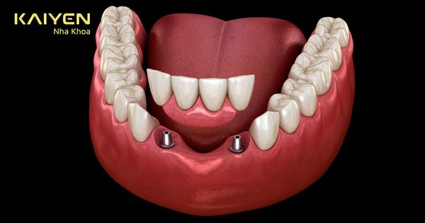 Trồng 4 răng cửa bằng phương pháp nào là tốt? Giá bao nhiêu?
