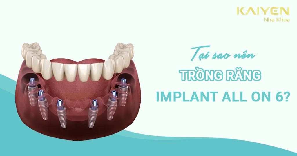 Implant All On 6 là gì? Tại sao nên trồng răng Implant All On 6?