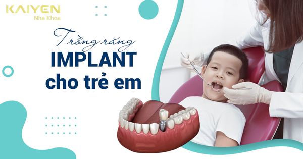 Trồng răng Implant cho trẻ em có được không? Độ tuổi nào thích hợp?