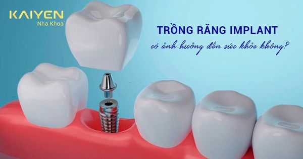 Trồng răng Implant có ảnh hưởng đến sức khỏe không?
