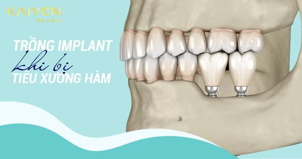 Trồng Implant khi bị tiêu xương hàm có nguy hiểm không?