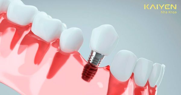 Trồng răng Implant lần 2 có được không? [Trước đó Implant bị đào thải]