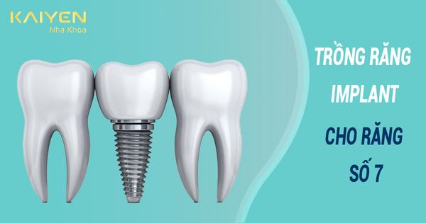 Trồng răng Implant số 7 mất bao lâu? Giá bao nhiêu tiền?