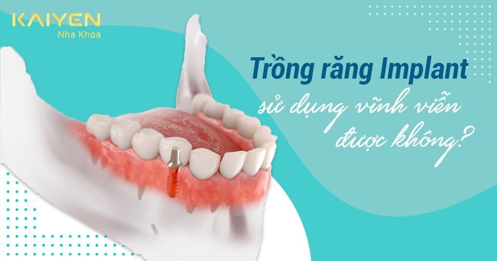 Trồng Implant Có Sử Dụng Được Vĩnh Viễn Không? Góc Nhìn Chuyên Gia Implant