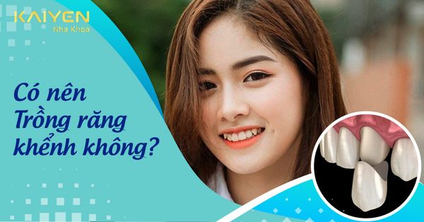 Có nên trồng răng khểnh không? Làm răng khểnh giá bao nhiêu?