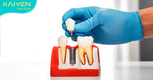 Trồng răng mất bao lâu để hoàn thiện? Chi tiết cho từng phương pháp