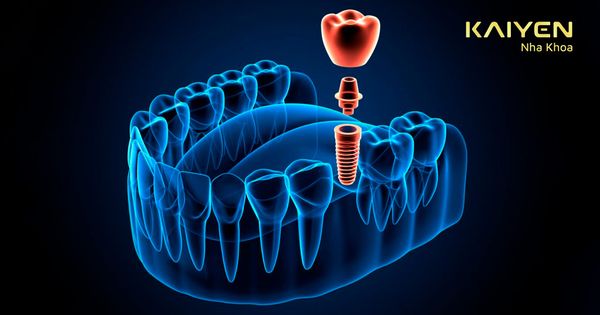 Có mấy phương pháp trồng răng nhai? Loại nào tốt và giá bao nhiêu?