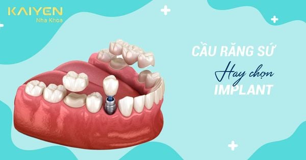 Mất Răng Nên Trồng Răng Sứ Hay Implant? Loại nào tốt?