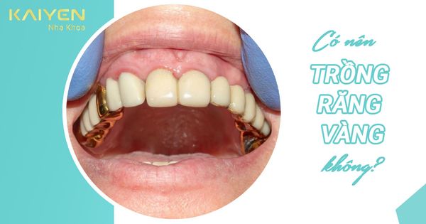 Trồng răng vàng là gì? Giá bao nhiêu? Có nên thực hiện không?