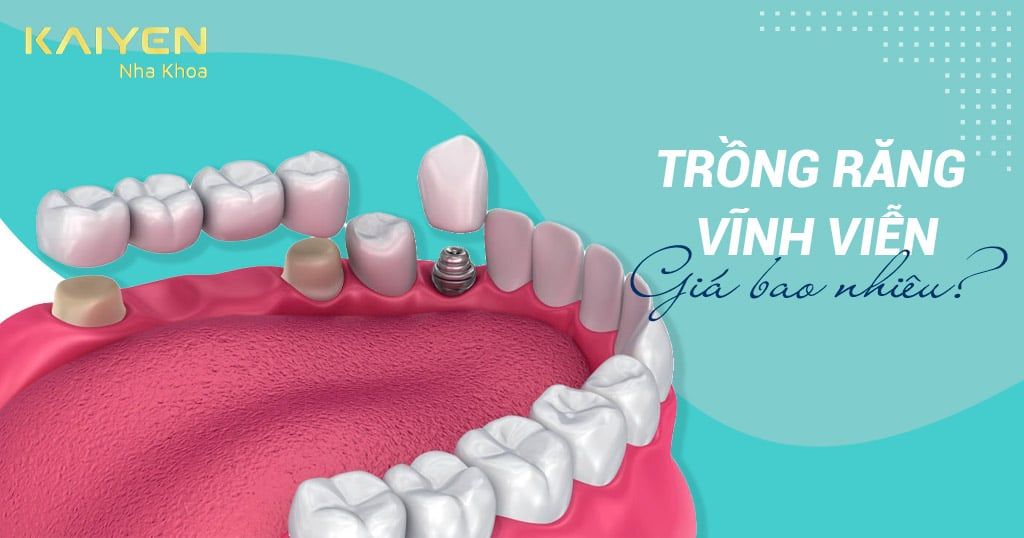 Trồng răng vĩnh viễn phương pháp nào tốt? Giá bao nhiêu?