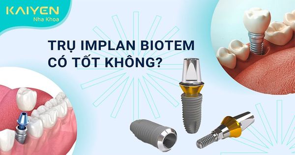 Trụ Implant Biotem có tốt không? Xuất xứ, cấu tạo, chi phí thực hiện