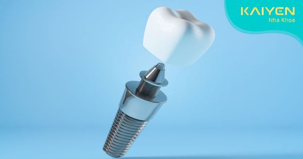 Trụ Implant Hiossen và những thông tin cần chú trọng