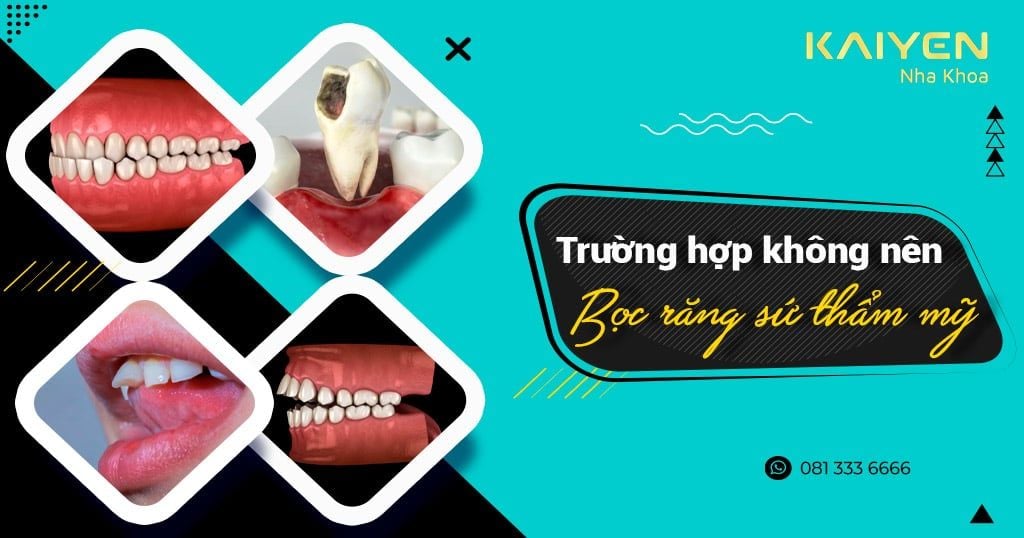 8 trường hợp không nên bọc răng sứ thẩm mỹ cần lưu ý
