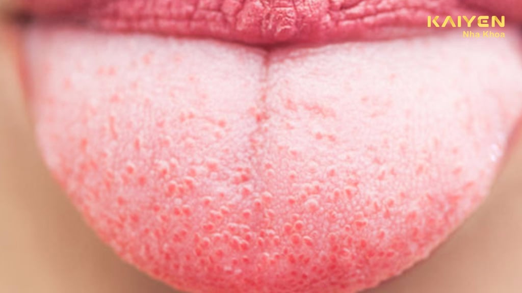 Tưa miệng là gì? Nguyên nhân và cách điều trị hiệu quả