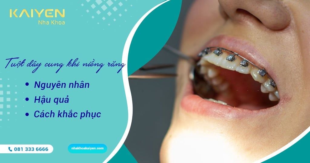 Tuột dây cung khi niềng răng: Nguyên nhân, hậu quả và cách khắc phục