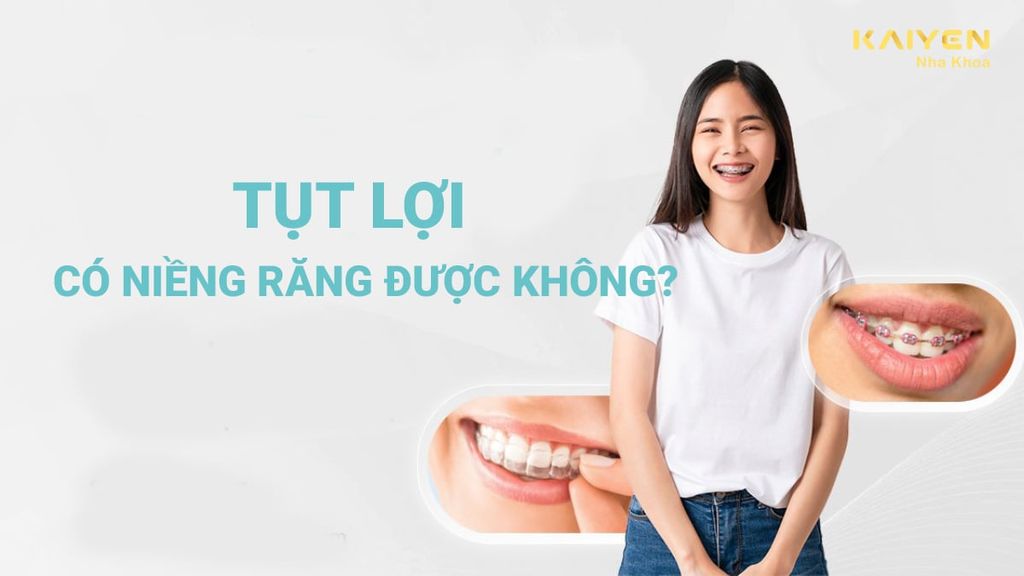 Tụt lợi có niềng răng được không? Cần lưu ý gì không?