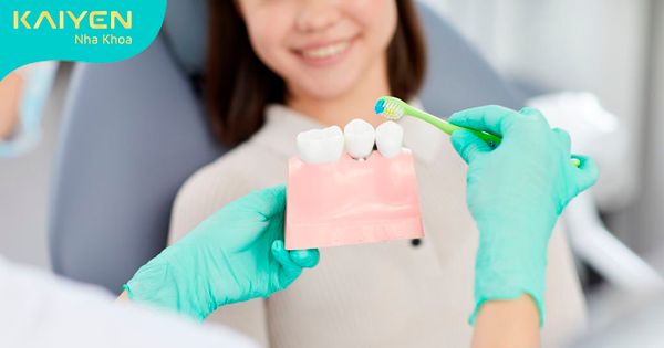 {Hướng dẫn} Vệ sinh răng Implant đúng cách cho tuổi thọ lâu dài