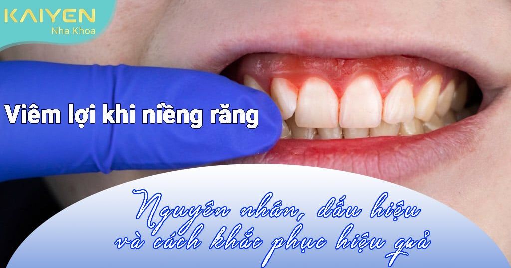 Viêm lợi khi niềng răng – Nguyên nhân, dấu hiệu và cách khắc phục hiệu quả