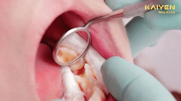 Chữa Tủy Răng Cho Bé Và Cách Phòng Ngừa Viêm Tủy Ở Trẻ