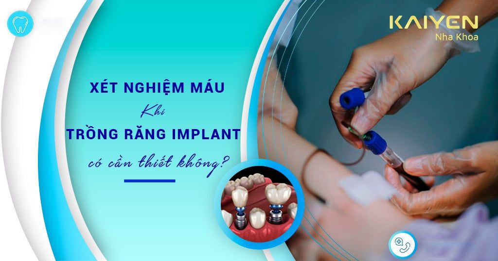 Xét nghiệm máu khi trồng răng Implant có cần thiết không?